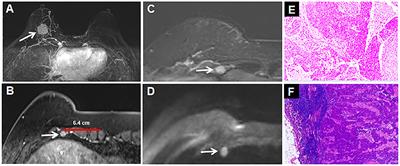 Case Report: Intercostal Lymph Node Metastasis: A Case Report and Review of the Literature